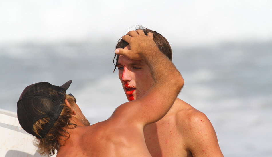 Injured. The ground swells were long and powerful and at some breaks it was downright mean! You can take a lot of heavy hits in the surf, but you\'ll get casualties. Two of our area\'s top surfers have been side lined for knee and ankle injuries. This is Matt Pruett checking the damage. Image: McCarthy