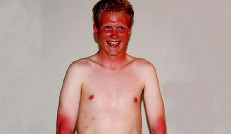 oc-man-suffers-incredibly-severe-sunburn-after-waiting-6-hours-for