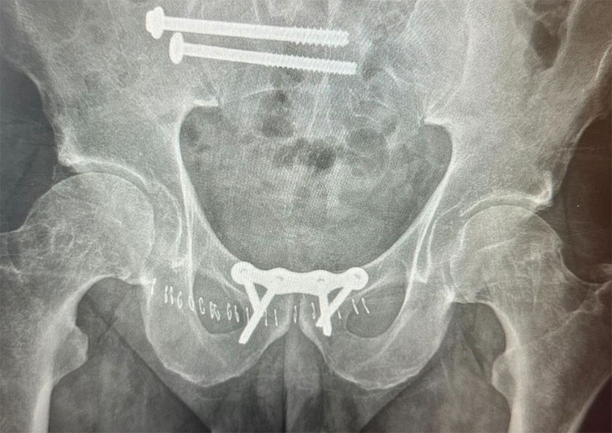 Coco Nogales pelvis