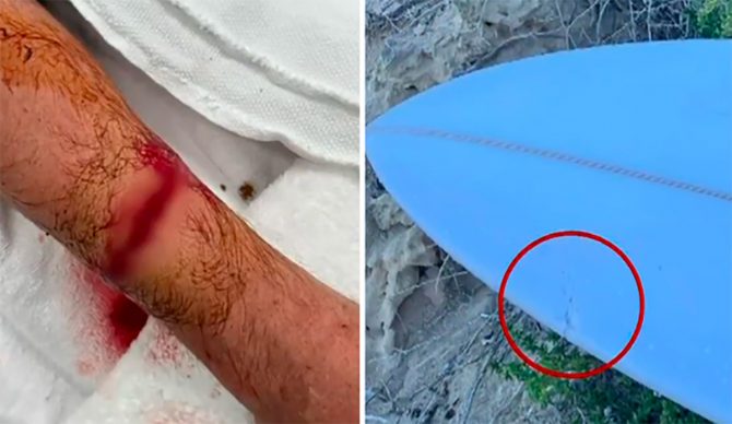 Surfer Attacked by Shark in Western Australia 