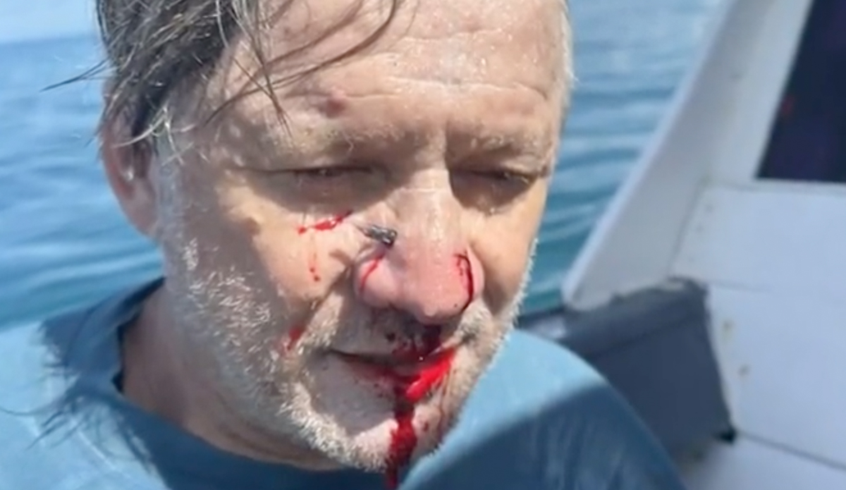 Steve Kezic on the way back to the mainland to have the fish removed from his face.