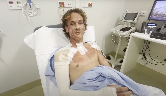 Jensen Kirby received burns to 13 percent of his body from an explosion that happened on an Indonesian surf trip. Photo: Jensen Kirby // YouTube